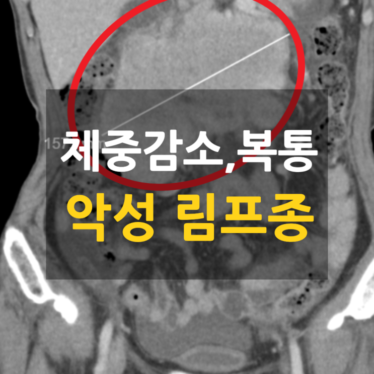 명치, 배꼽 주변 통증, 체중감소 — 악성림프종 의심