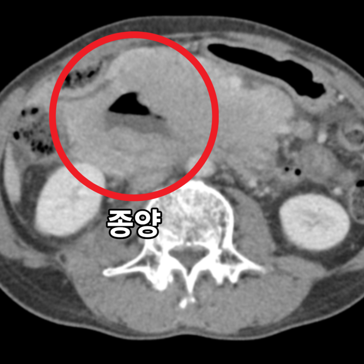 복부CT 관상면: 종양 크기 157.9mm 측정