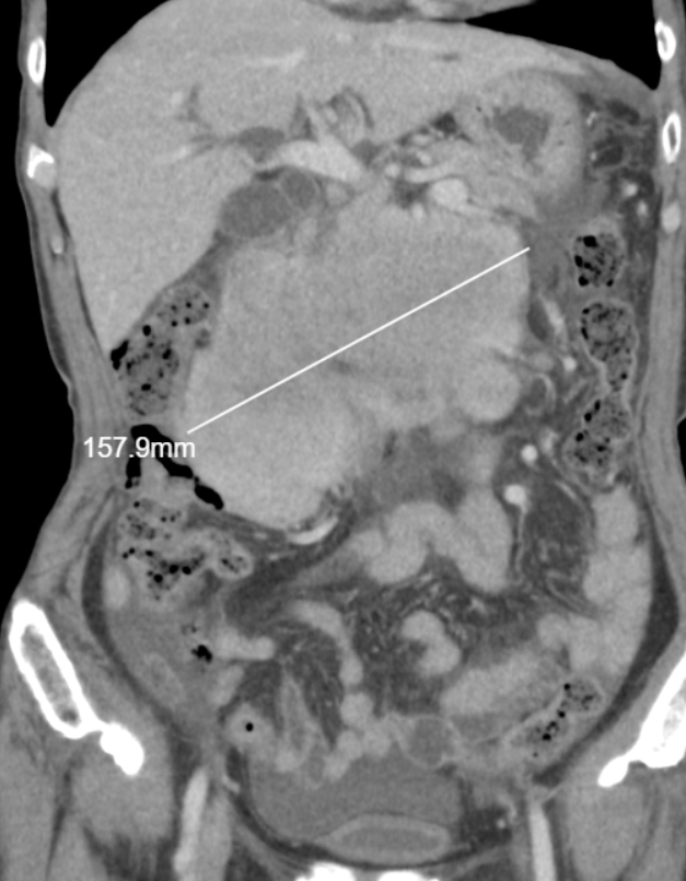 복부CT 횡단면: 복수 확인(빨간 동그라미)