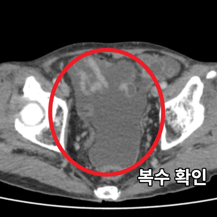 복부CT 횡단면: 복수 확인(빨간 동그라미)