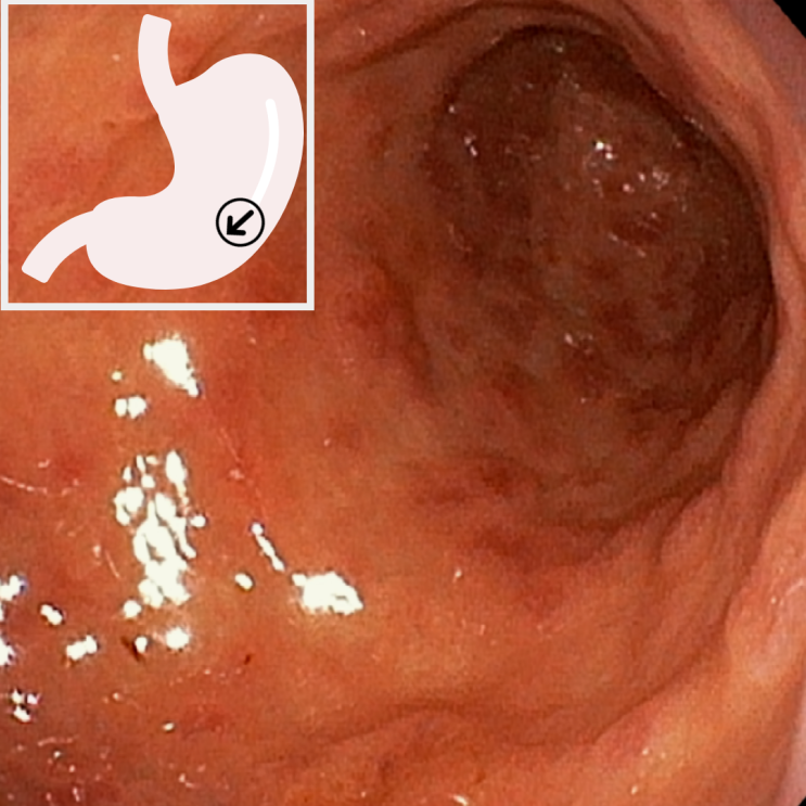 국가검진 위내시경, 중증 위선종 고등급 위암 가능성