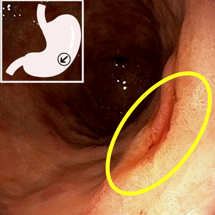 위내시경 확대 소견: 고등급 이형성 의심 병변의 표면 구조