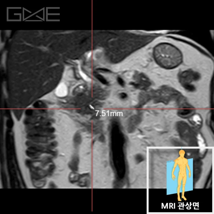 복부초음파 이상 소견 > 췌장 MRI > 췌장 낭종