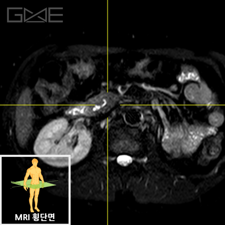 복부 MRI MRCP 3D 재구성: 췌장 낭종 위치 표시