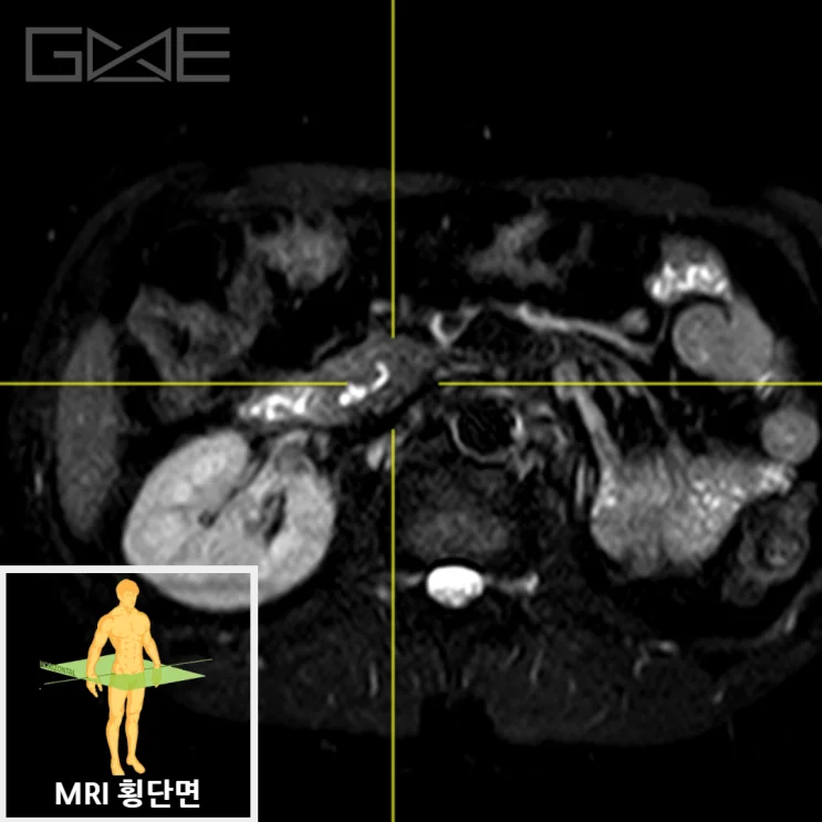 복부 MRI MRCP 3D 재구성: 췌장 낭종 위치 표시