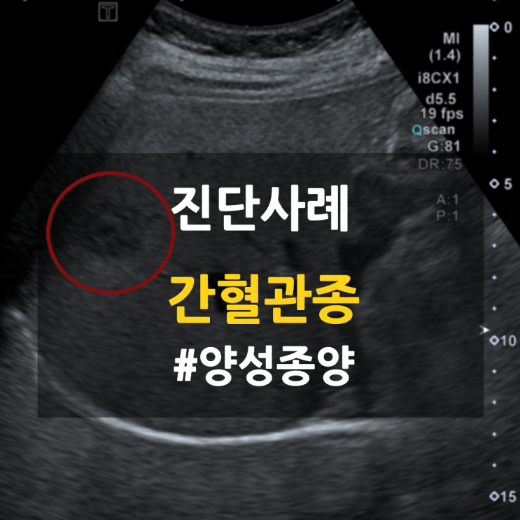상복부초음파: 우측 위 중등부 저에코 결절 (붉은 동그라미)