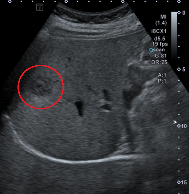 복부CT 동맥기: 간의 양성 종양 병변 (붉은 동그라미)