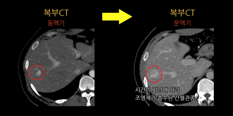 간의 양성 종양 및 악성 종양 구분 참고도