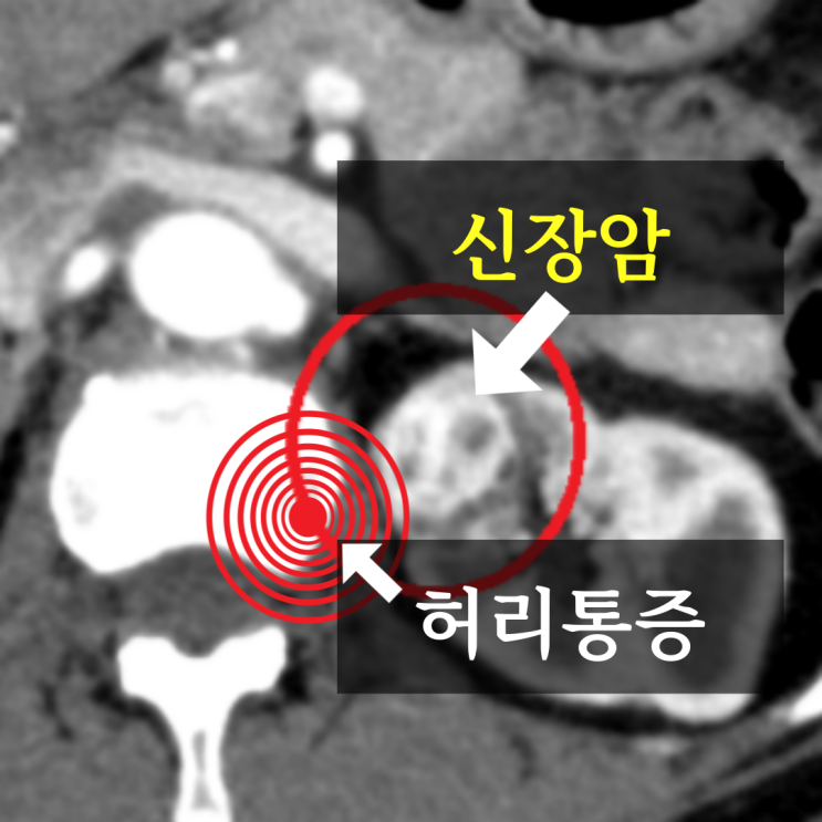 복부CT 횡단면: 왼쪽 신장 병변