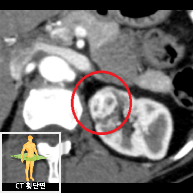 복부CT 관상면: 왼쪽 신장암 3.3cm 크기 병변