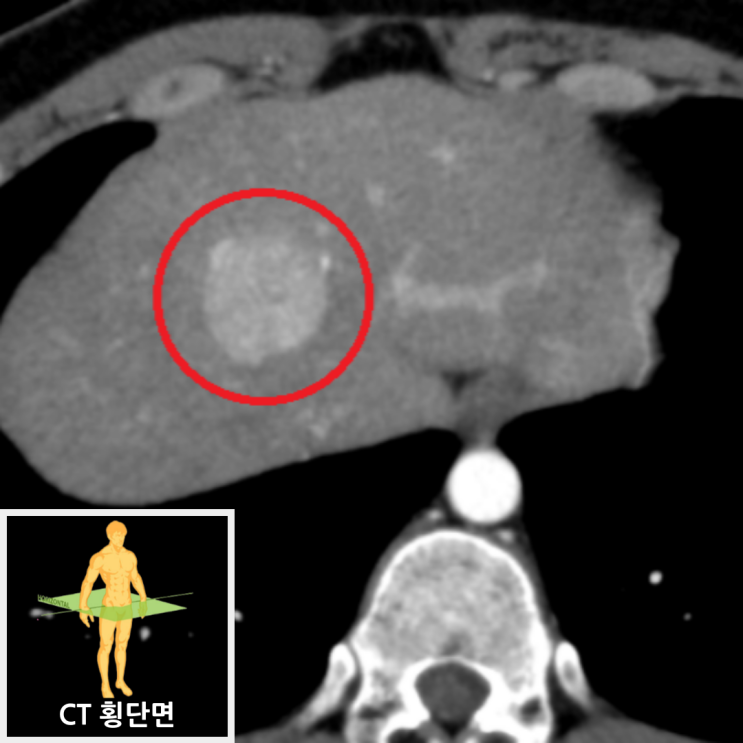 복부CT: 간 중간 엽 3cm 고음영 결절