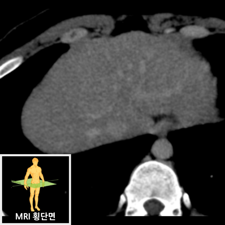 복부MRI 20분 지연 영상: 국소결절과형성 확인