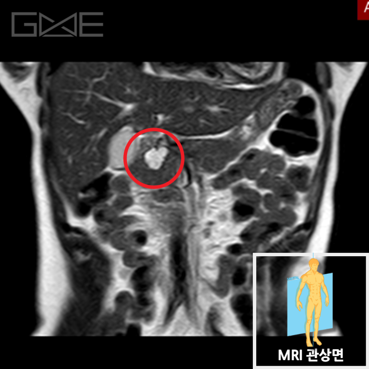 췌장MRI: 갈고리돌기(uncinate process) 쪽 2cm 저신호 결절