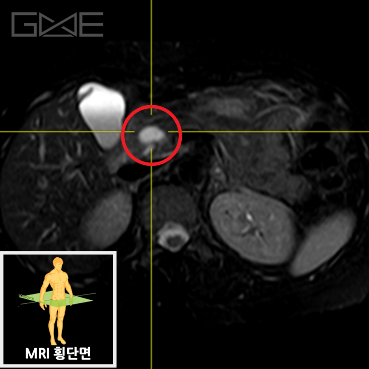 소화불량, 췌장결절 — 췌장암 진단