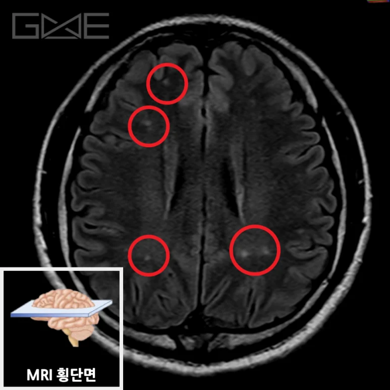 동일 환자의 여러 뇌백질 고신호 부위를 붉은 원으로 표시한 뇌 MRI 횡단면 영상