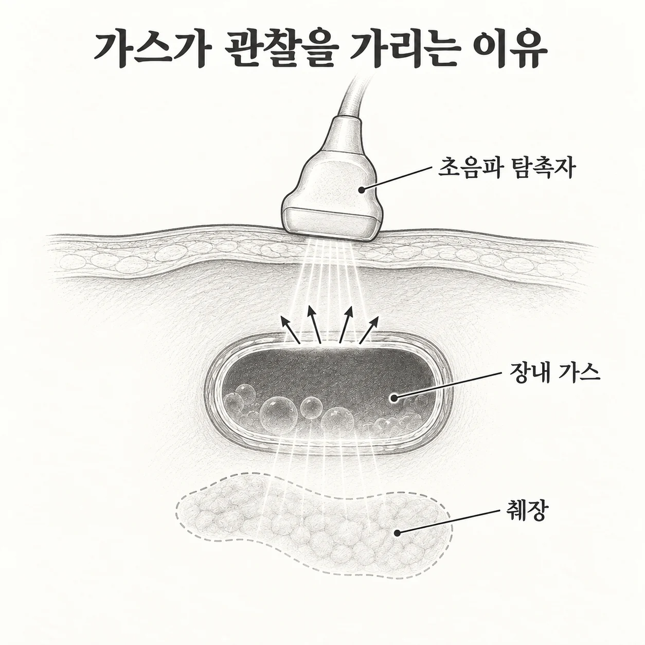장내 가스 뒤쪽의 췌장 관찰이 제한되는 원리를 보여주는 도해