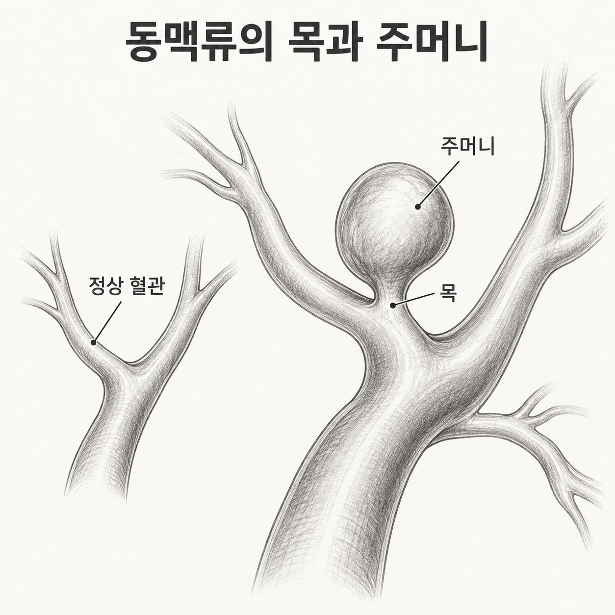 정상 혈관과 주머니 형태의 동맥류, 목 부분을 비교한 도해