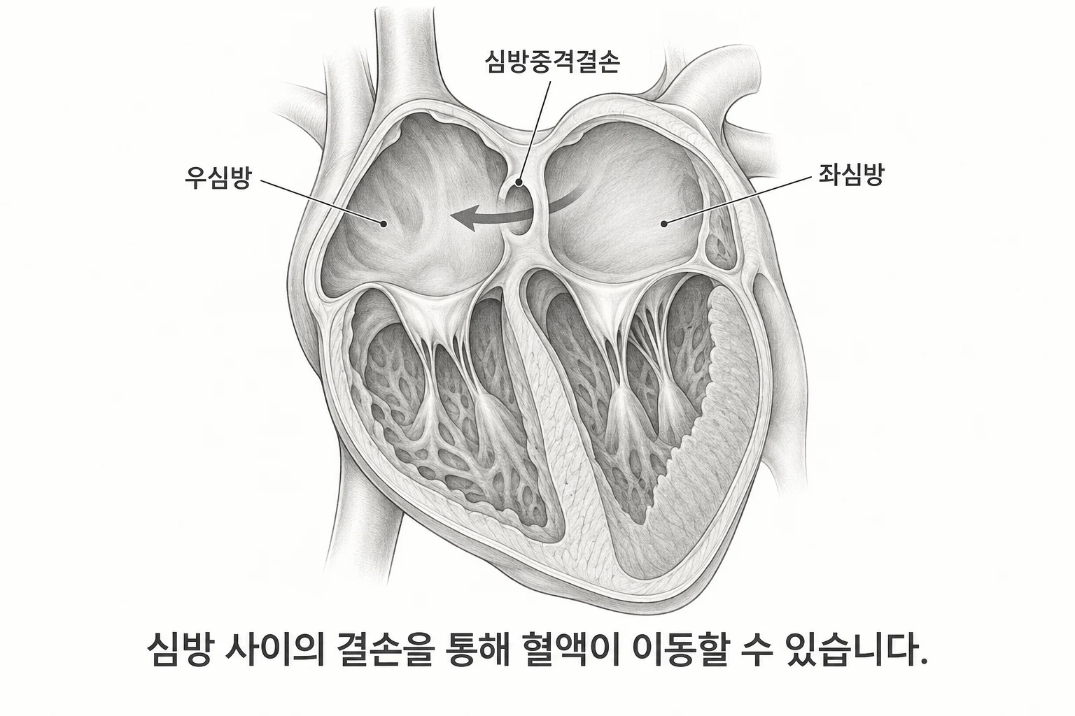 우심방과 좌심방 사이의 심방중격결손을 통해 혈액이 이동하는 원리를 설명한 심장 단면 도해