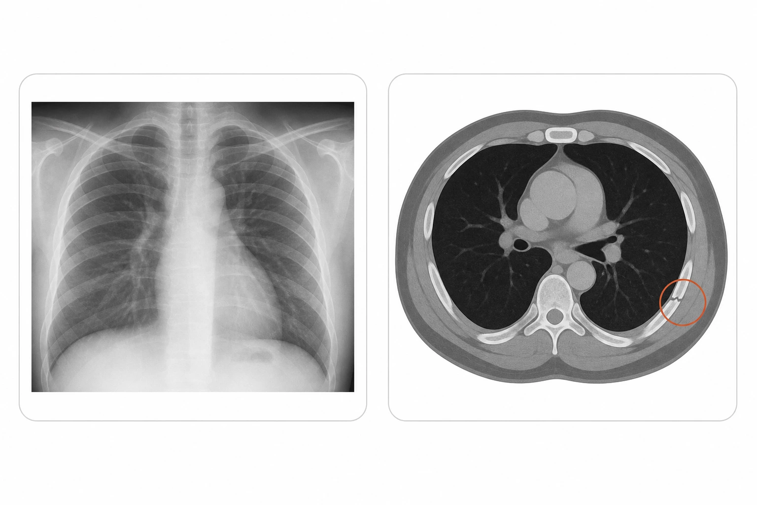 왼쪽은 갈비뼈가 겹쳐 보이는 흉부 X-ray, 오른쪽은 흉부 CT 단면에서 갈비뼈 한 곳의 가는 골절선을 원으로 표시한 비교 도해