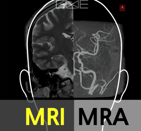 뇌MRA (Brain MRA) | 분당 판교 영상의학과가 있는 내과 & 검진센터ㅣ지앤이 알파돔 메디컬센터