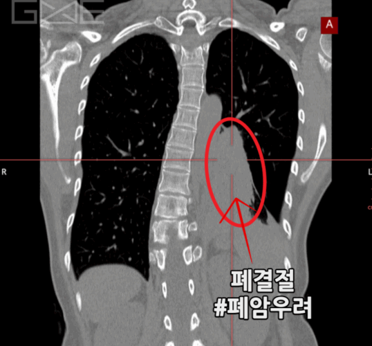 폐결절 폐암