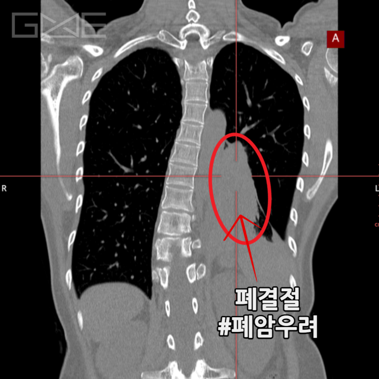 흉부(폐CT) (Low-dose Chest CT) | 분당 판교 영상의학과가 있는 내과 & 검진센터ㅣ지앤이 알파돔 메디컬센터